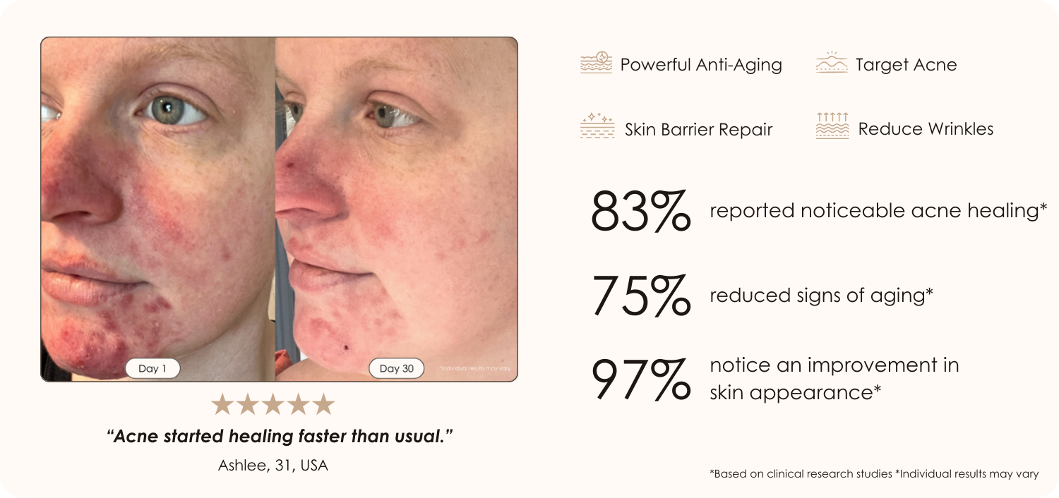 LightAura Plus LED face neck mask light therapy before and after results showing reduced acne after 30 days