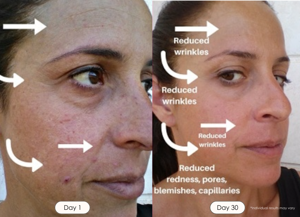 LightAura Plus LED face neck mask light therapy before and after results showing reduced wrinkles smaller pores capillaries after 30 days