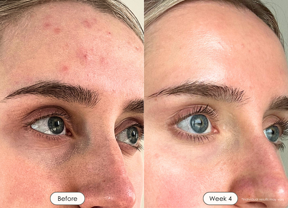 visible results after 30 days of using the LED light therapy mask